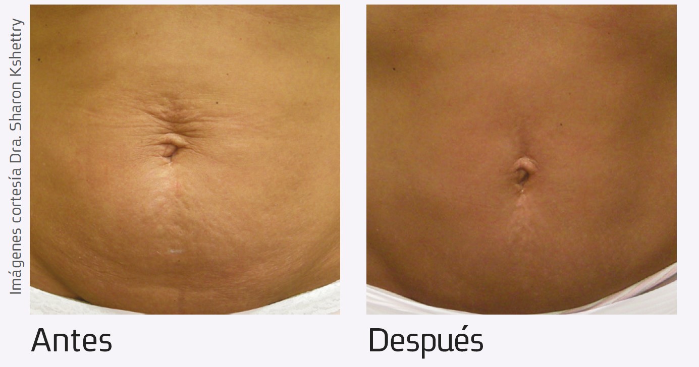 Nur-aesthetics-antes-depois-1