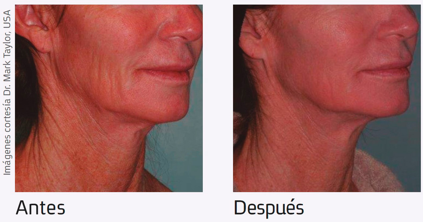 Nur-aesthetics-antes-depois-2