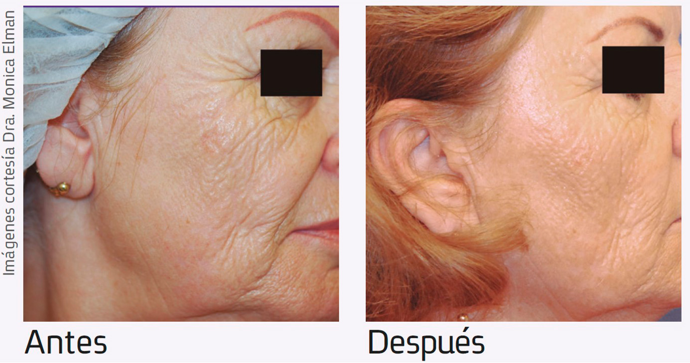 Nur-aesthetics-antes-depois-5