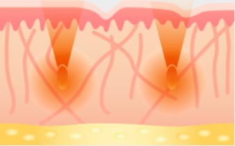 Nur-aesthetics-derme-2