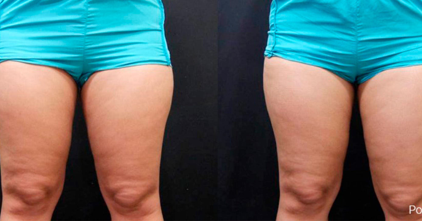 Nuraesthetics antes-depois