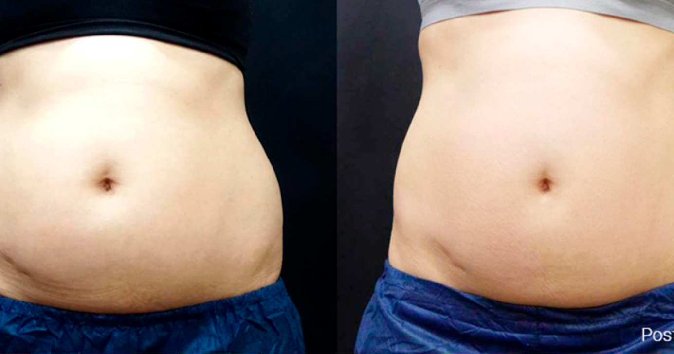 Nuraesthetics antes-depois