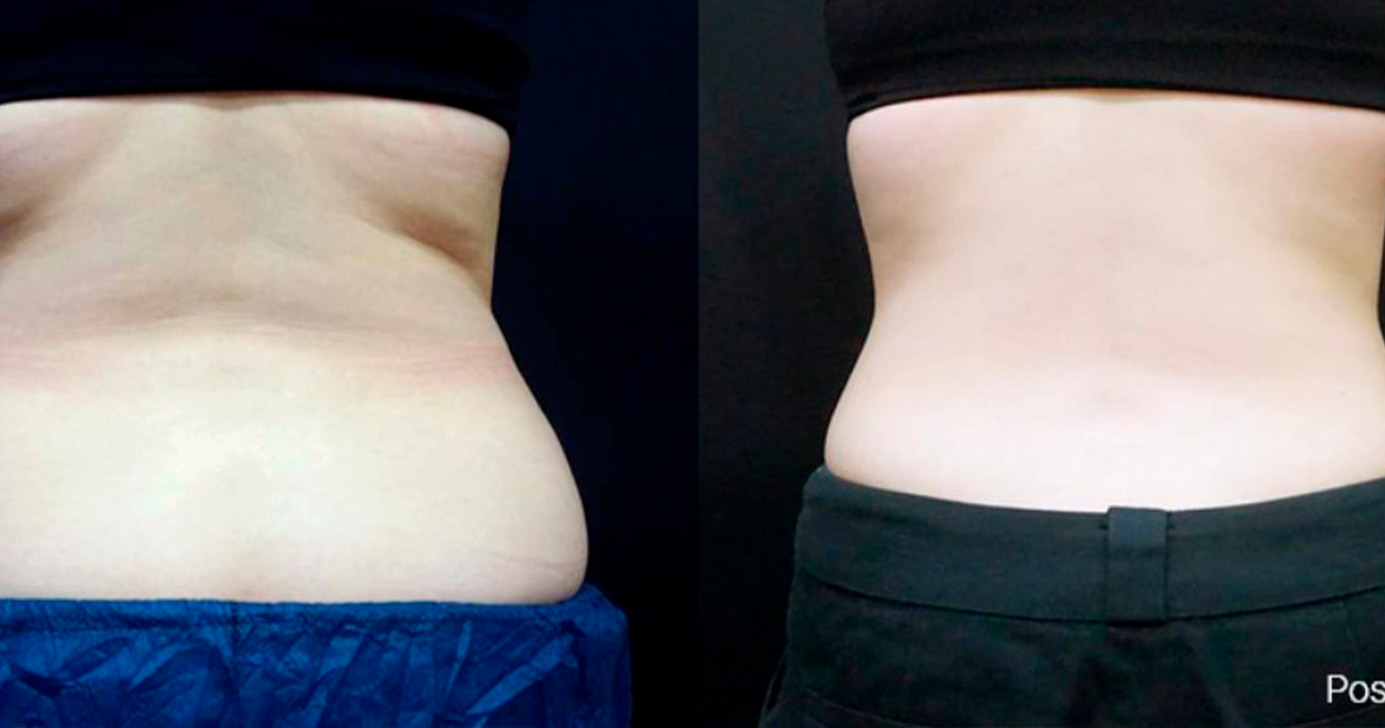Nuraesthetics antes-depois-ulfit