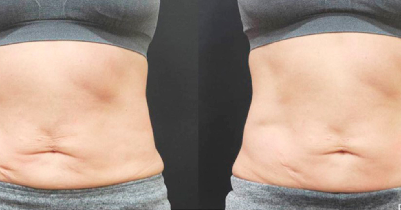 Nuraesthetics antes-depois-ulfit