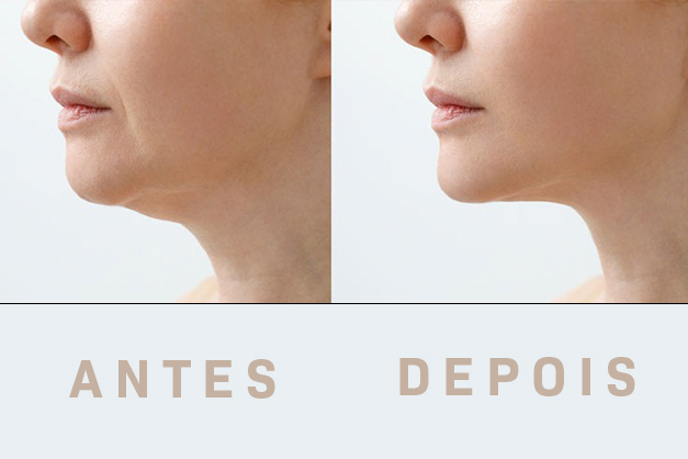 Endolaser_antes_depois