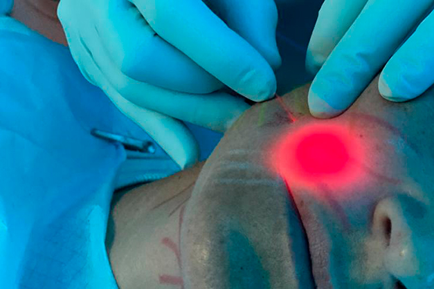 endolaser_treatment_aesthetic_nur