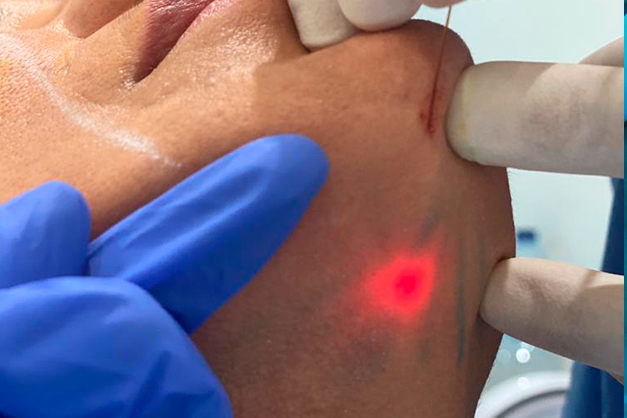 endolaser_treatment_aesthetic_nur_algarve